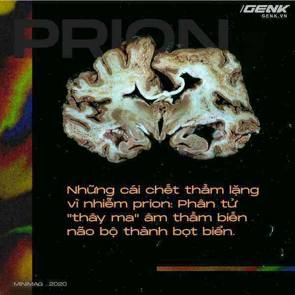 Những cái chết thầm lặng vì nhiễm prion: Phân tử thây ma âm thầm biến não bộ thành bọt biển