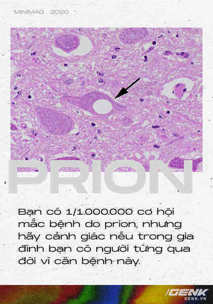 Những cái chết thầm lặng vì nhiễm prion: Phân tử thây ma âm thầm biến não bộ thành bọt biển - Ảnh 10. Những cái chết thầm lặng vì nhiễm prion: Phân tử thây ma âm thầm biến não bộ thành bọt biển - Ảnh 10.