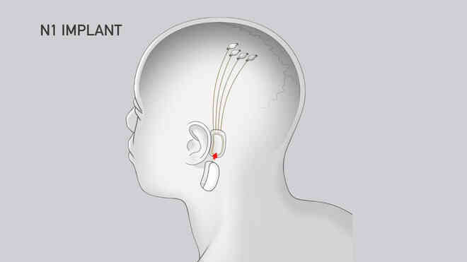 Neuralink và tham vọng cộng sinh với trí tuệ nhân tạo của Elon Musk - Ảnh 6. Neuralink và tham vọng cộng sinh với trí tuệ nhân tạo của Elon Musk - Ảnh 6.
