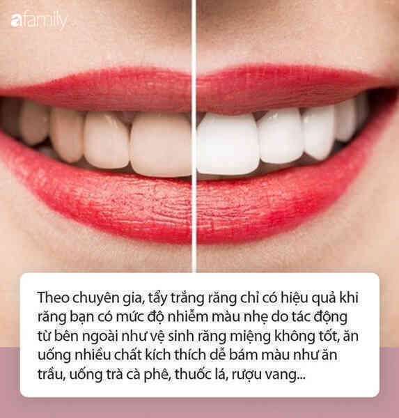 Học cách sử dụng hydrogen peroxide để làm trắng răng như trên Tik Tok: Chuyên gia khuyến cáo cần hết sức cẩn trọng! - Ảnh 2. Học cách sử dụng hydrogen peroxide để làm trắng răng như trên Tik Tok: Chuyên gia khuyến cáo cần hết sức cẩn trọng! - Ảnh 2.