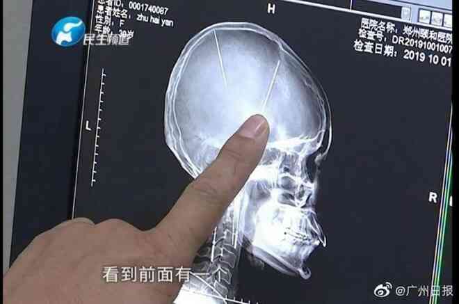 Sau tai nạn ô tô người phụ nữ Trung Quốc bất ngờ phát hiện có hai cây kim được găm vào trong não mà không hề có ký ức gì