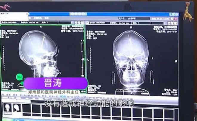 Sau tai nạn ô tô người phụ nữ Trung Quốc bất ngờ phát hiện có hai cây kim được găm vào trong não mà không hề có ký ức gì - Ảnh 2. Sau tai nạn ô tô người phụ nữ Trung Quốc bất ngờ phát hiện có hai cây kim được găm vào trong não mà không hề có ký ức gì - Ảnh 2.