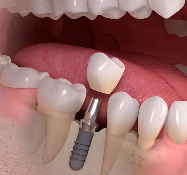 Bước tiến lớn trong công nghệ cấy ghép implant tại Việt Nam - Ảnh 3.