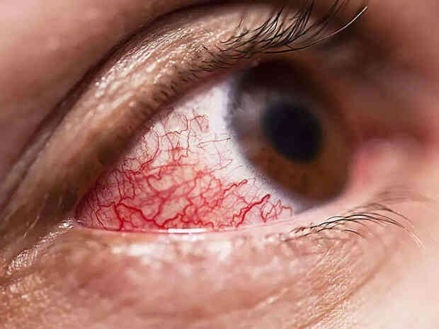 Mù lòa và thậm chí tử vong sau khi phục hồi, biến thể mới của Covid-19 ở Ấn Độ đáng sợ đến mức nào? - Ảnh 3. Mù lòa và thậm chí tử vong sau khi phục hồi, biến thể mới của Covid-19 ở Ấn Độ đáng sợ đến mức nào? - Ảnh 3.