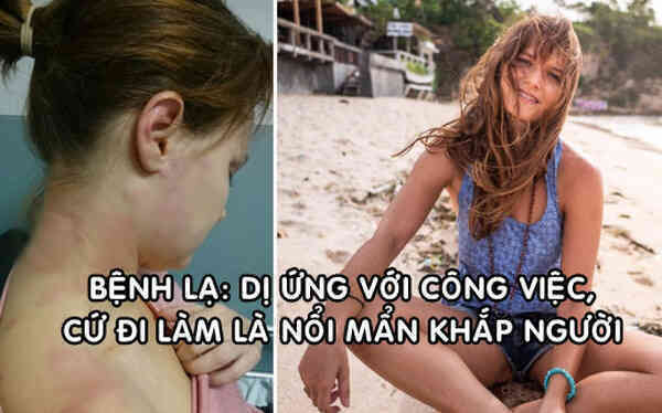 Cô gái mắc bệnh dị ứng nặng với... công việc, bỏ làm chu du khắp thế giới liền khỏi bệnh