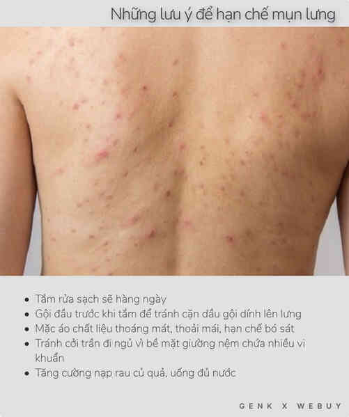 Cởi trần đi ngủ rất dễ bị mụn lưng và 5 sản phẩm giá từ 32k để các chàng trai xử đẹp vấn đề này - Ảnh 7.