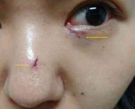 Người phụ nữ bị đũa cắm vào sọ suốt 1 tuần mà không hề hay biết