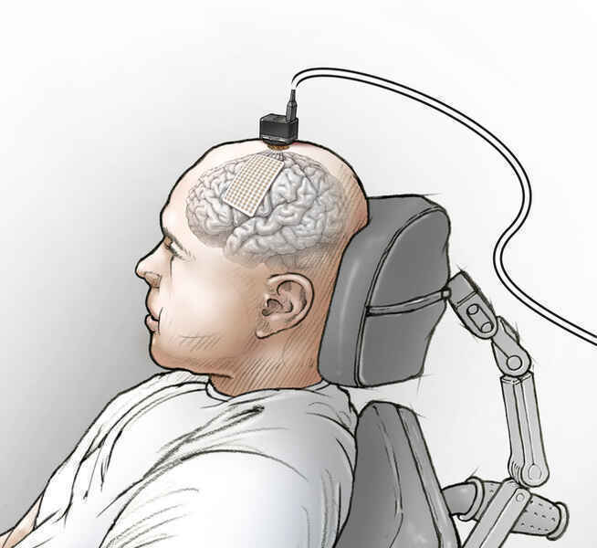 Các nhà khoa học nối não của một người câm với máy tính, và bây giờ anh ấy đã nói được