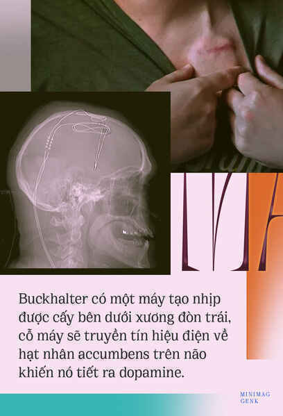 Người Mỹ đầu tiên được chữa khỏi nghiện ma túy bằng phẫu thuật não - Ảnh 17. Người Mỹ đầu tiên được chữa khỏi nghiện ma túy bằng phẫu thuật não - Ảnh 17.