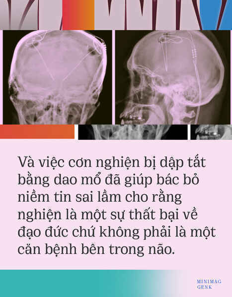 Người Mỹ đầu tiên được chữa khỏi nghiện ma túy bằng phẫu thuật não - Ảnh 3. Người Mỹ đầu tiên được chữa khỏi nghiện ma túy bằng phẫu thuật não - Ảnh 3.