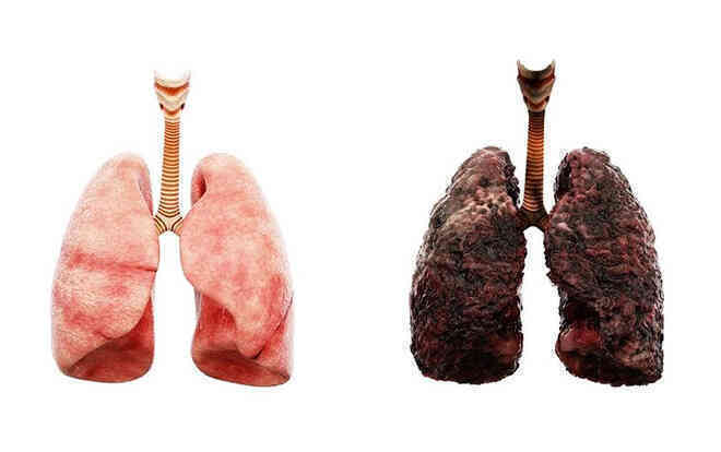 Nghiên cứu mới tìm thấy 3 dạng ung thư phổi ở những người chưa bao giờ hút thuốc, có loại phát sinh sớm tới 10 năm - Ảnh 1. Nghiên cứu mới tìm thấy 3 dạng ung thư phổi ở những người chưa bao giờ hút thuốc, có loại phát sinh sớm tới 10 năm - Ảnh 1.