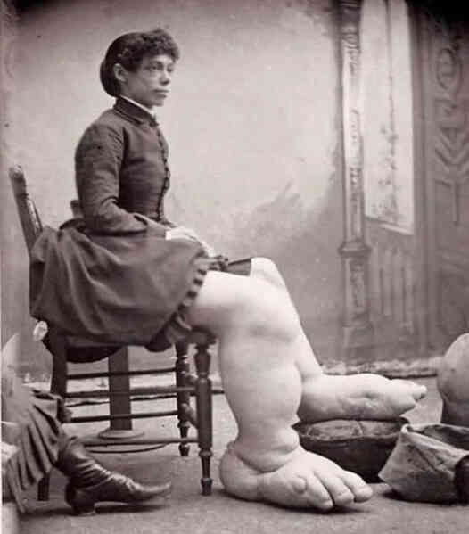 Fanny Mills - Cô gái chân to Ohio, người được mệnh danh là có đôi bàn chân to nhất Trái Đất!