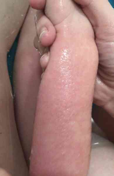 Anonychia – Một tình trạng hiếm gặp, khiến cho con người không có móng tay và móng chân - Ảnh 3. Anonychia – Một tình trạng hiếm gặp, khiến cho con người không có móng tay và móng chân - Ảnh 3.