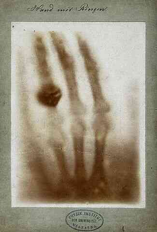 First_medical_X-ray_by_Wilhelm_Röntgen_of_his_wife_Anna_Bertha_Ludwig's_hand_-_18951222.jpg First_medical_X-ray_by_Wilhelm_Röntgen_of_his_wife_Anna_Bertha_Ludwig's_hand_-_18951222.jpg
