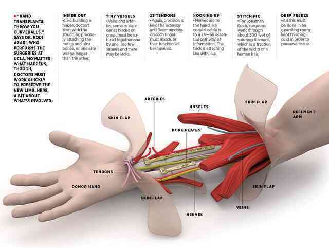 30 bác sĩ phẫu thuật trong 12 tiếng giúp người đàn ông ghép đôi bàn tay mới - Ảnh 5.