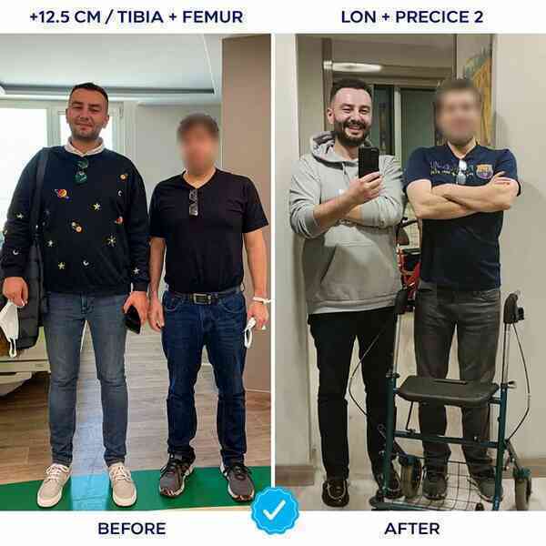 Khoa Pug chi 2 tỷ kéo dài chân lên 1m8: Đây là chi tiết về ca phẫu thuật anh ấy sẽ thực hiện - Ảnh 16. Khoa Pug chi 2 tỷ kéo dài chân lên 1m8: Đây là chi tiết về ca phẫu thuật anh ấy sẽ thực hiện - Ảnh 16.