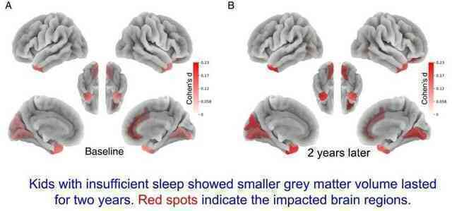 Đại học Y khoa của Mỹ phát hiện: Trẻ ngủ không đủ 9 giờ mỗi đêm sẽ có ít chất xám hơn