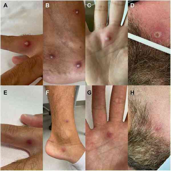 Việt Nam ghi nhận 4 ca nhiễm đậu mùa khỉ trong cộng đồng: Chuyên gia cảnh báo đó mới chỉ là "phần nổi của tảng băng" - Ảnh 4. Việt Nam ghi nhận 4 ca nhiễm đậu mùa khỉ trong cộng đồng: Chuyên gia cảnh báo đó mới chỉ là "phần nổi của tảng băng" - Ảnh 4.