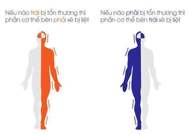 Đột phá: Công nghệ giúp người tai biến liệt 10 năm cử động lại được, giá chỉ 350 triệu VNĐ