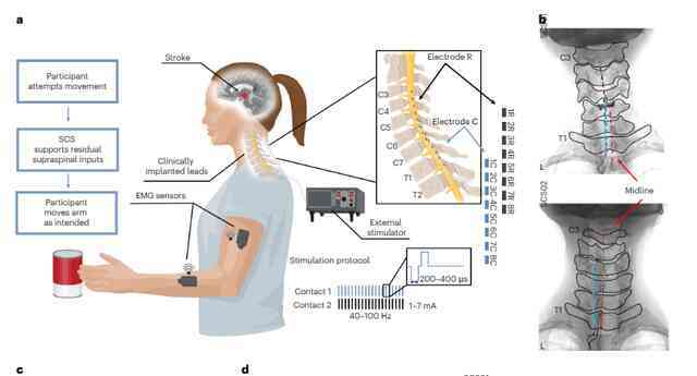 Đột phá: Công nghệ giúp người tai biến liệt 10 năm cử động lại được, giá chỉ 350 triệu VNĐ - Ảnh 7. Đột phá: Công nghệ giúp người tai biến liệt 10 năm cử động lại được, giá chỉ 350 triệu VNĐ - Ảnh 7.