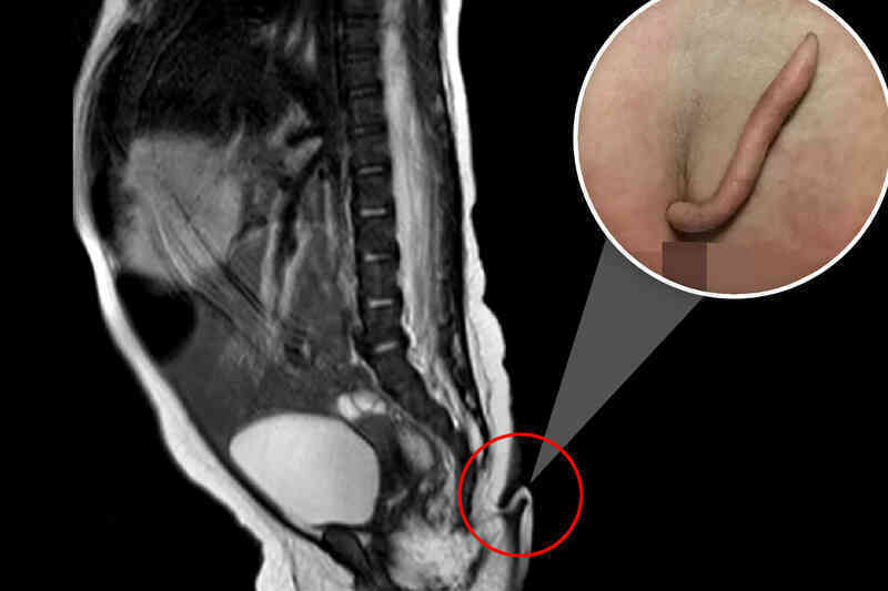 Tại sao một số người sinh ra có đuôi như động vật?
