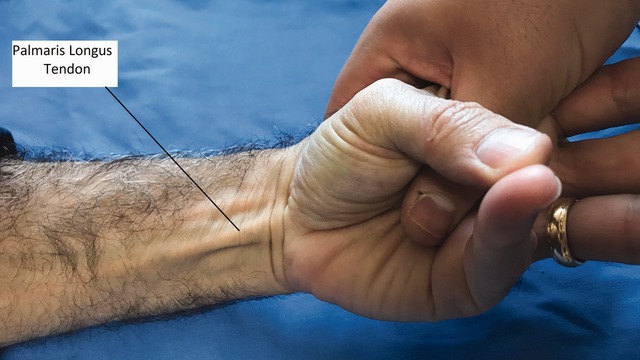 Tại sao một số người không có cơ palmaris longus? - Ảnh 2. Tại sao một số người không có cơ palmaris longus? - Ảnh 2.