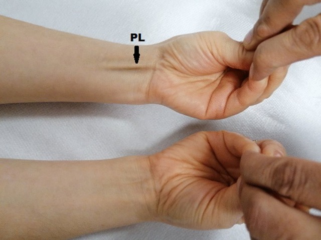 Tại sao một số người không có cơ palmaris longus? - Ảnh 3. Tại sao một số người không có cơ palmaris longus? - Ảnh 3.