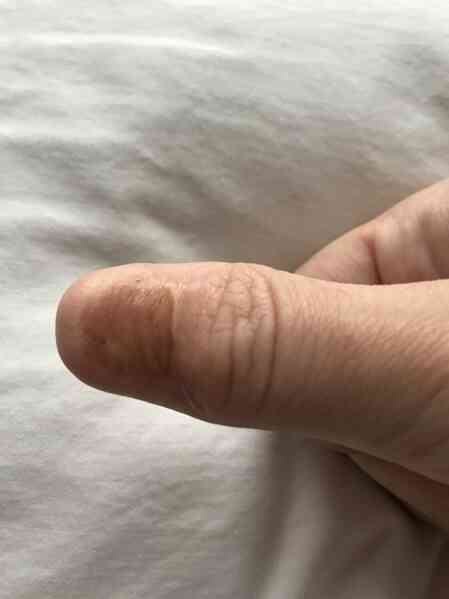 Vệt kẻ trông như nét bút chì dưới móng tay lại có thể là dấu hiệu cho thấy bạn đang mắc ung thư- Ảnh 4. Vệt kẻ trông như nét bút chì dưới móng tay lại có thể là dấu hiệu cho thấy bạn đang mắc ung thư- Ảnh 4.