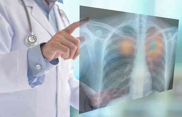 Thứ gây ra 90% số ca ung thư phổi đang quẩn quanh người Việt: Thích đến mấy cũng nên bỏ