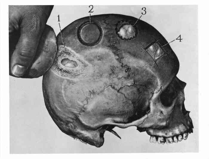 Trepanation: Thủ tục phẫu thuật sọ lâu đời nhất thế giới vẫn tồn tại đến ngày nay!- Ảnh 3. Trepanation: Thủ tục phẫu thuật sọ lâu đời nhất thế giới vẫn tồn tại đến ngày nay!- Ảnh 3.