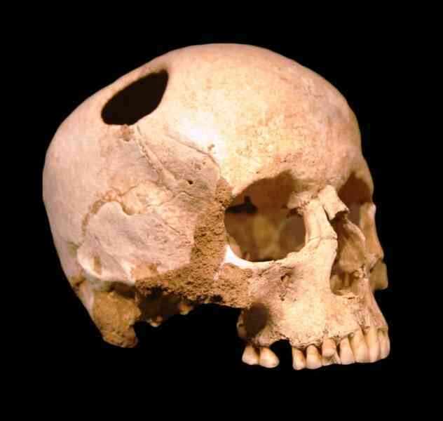 Trepanation: Thủ tục phẫu thuật sọ lâu đời nhất thế giới vẫn tồn tại đến ngày nay!- Ảnh 4. Trepanation: Thủ tục phẫu thuật sọ lâu đời nhất thế giới vẫn tồn tại đến ngày nay!- Ảnh 4.