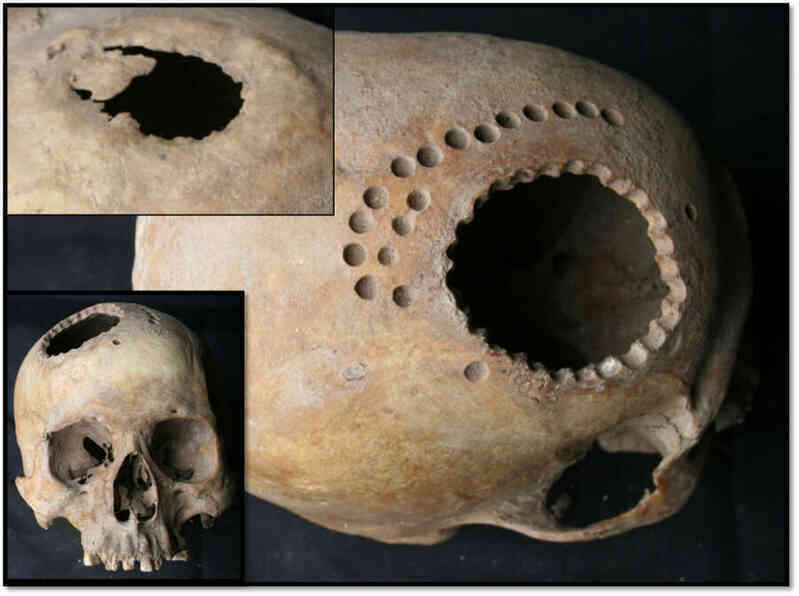 Trepanation: Thủ tục phẫu thuật sọ lâu đời nhất thế giới vẫn tồn tại đến ngày nay!- Ảnh 5. Trepanation: Thủ tục phẫu thuật sọ lâu đời nhất thế giới vẫn tồn tại đến ngày nay!- Ảnh 5.