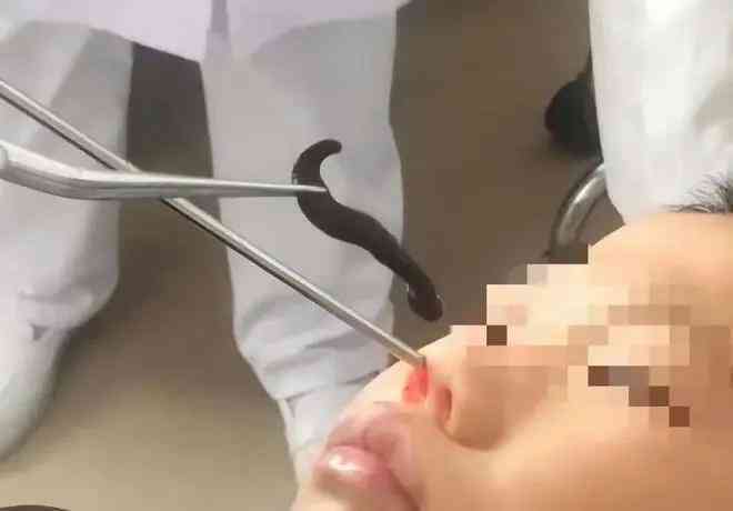 Đỉa có thể tồn tại trong mũi hơn nửa tháng, tại sao sức sống của chúng lại ngoan cường như vậy?