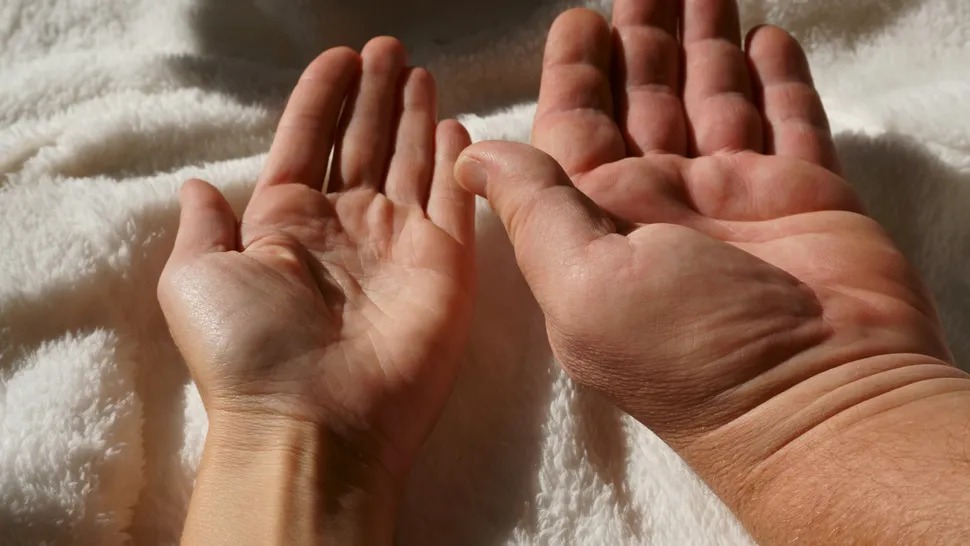 Acromegaly: Một căn bệnh hiếm gặp, khiến người lớn phát triển không kiểm soát được