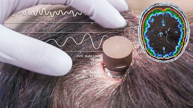 Elon Musk: Người đầu tiên được cấy chip Neuralink vào não đã điều khiển được chuột máy tính 'chỉ bằng suy nghĩ'