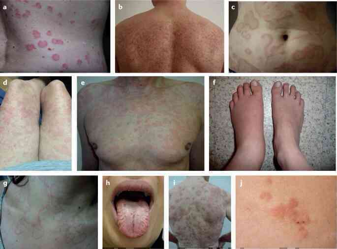 Không tắm, không rửa tay, không đổ mồ hôi và không được khóc: Cuộc sống của những bệnh nhân dị ứng với nước- Ảnh 13. Không tắm, không rửa tay, không đổ mồ hôi và không được khóc: Cuộc sống của những bệnh nhân dị ứng với nước- Ảnh 13.