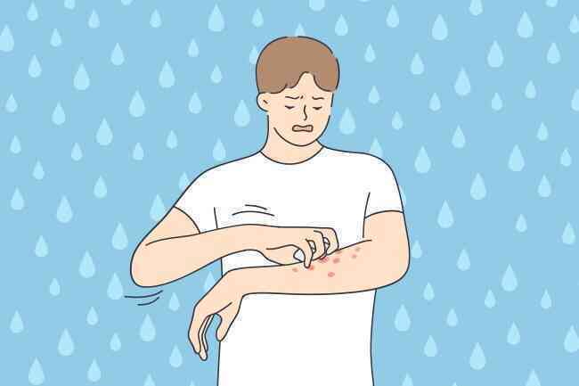 Không tắm, không rửa tay, không đổ mồ hôi và không được khóc: Cuộc sống của những bệnh nhân dị ứng với nước- Ảnh 3. Không tắm, không rửa tay, không đổ mồ hôi và không được khóc: Cuộc sống của những bệnh nhân dị ứng với nước- Ảnh 3.