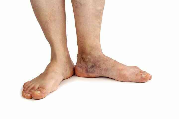 Suy giãn tĩnh mạch chân: Dấu hiệu và biến chứng- Ảnh 2.