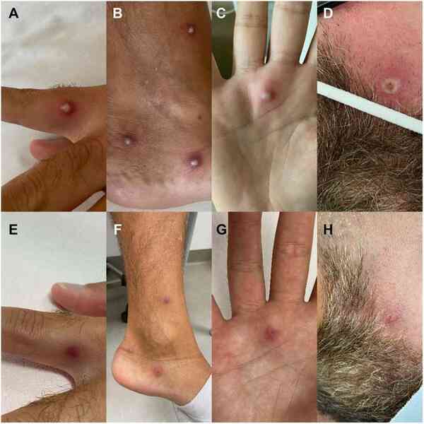 Châu Phi tuyên bố tình trạng khẩn cấp toàn lục địa với bệnh đậu mùa khỉ: Liệu một đại dịch toàn cầu mới có bùng phát?- Ảnh 2. Châu Phi tuyên bố tình trạng khẩn cấp toàn lục địa với bệnh đậu mùa khỉ: Liệu một đại dịch toàn cầu mới có bùng phát?- Ảnh 2.