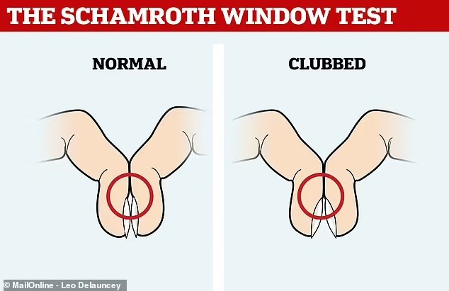 Tự thử 5 giây với ngón tay để biết ngay có bị ung thư hay không- Ảnh 2. Tự thử 5 giây với ngón tay để biết ngay có bị ung thư hay không- Ảnh 2.