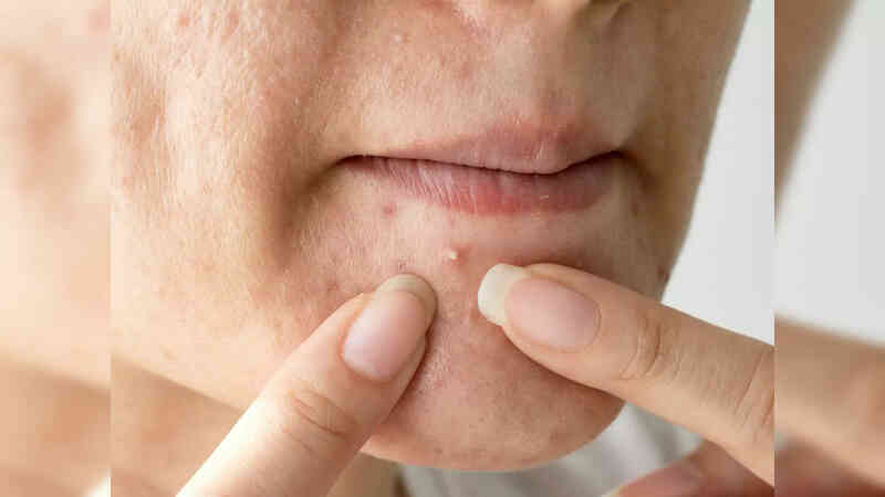 Mụn trứng cá có thể mang lại lợi ích bất ngờ cho quá trình lão hóa- Ảnh 4. Mụn trứng cá có thể mang lại lợi ích bất ngờ cho quá trình lão hóa- Ảnh 4.