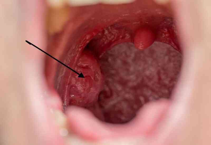 Người đàn ông bất ngờ phát hiện mắc ung thư ở miệng, vì chủng virus anh nghĩ chỉ lây nhiễm tử cung phụ nữ- Ảnh 3. Người đàn ông bất ngờ phát hiện mắc ung thư ở miệng, vì chủng virus anh nghĩ chỉ lây nhiễm tử cung phụ nữ- Ảnh 3.