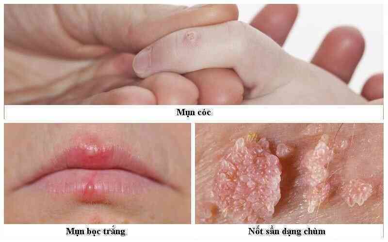 Người đàn ông bất ngờ phát hiện mắc ung thư ở miệng, vì chủng virus anh nghĩ chỉ lây nhiễm tử cung phụ nữ- Ảnh 5. Người đàn ông bất ngờ phát hiện mắc ung thư ở miệng, vì chủng virus anh nghĩ chỉ lây nhiễm tử cung phụ nữ- Ảnh 5.