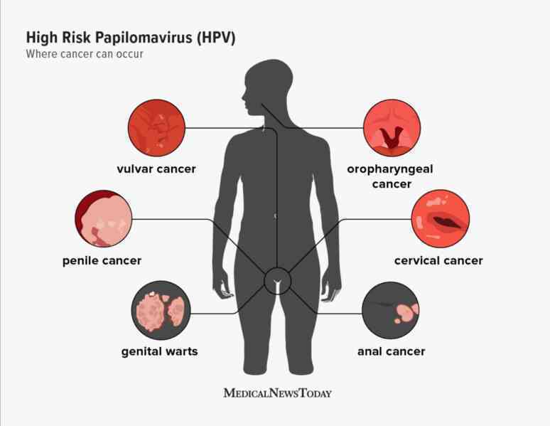 Người đàn ông bất ngờ phát hiện mắc ung thư ở miệng, vì chủng virus anh nghĩ chỉ lây nhiễm tử cung phụ nữ- Ảnh 7. Người đàn ông bất ngờ phát hiện mắc ung thư ở miệng, vì chủng virus anh nghĩ chỉ lây nhiễm tử cung phụ nữ- Ảnh 7.