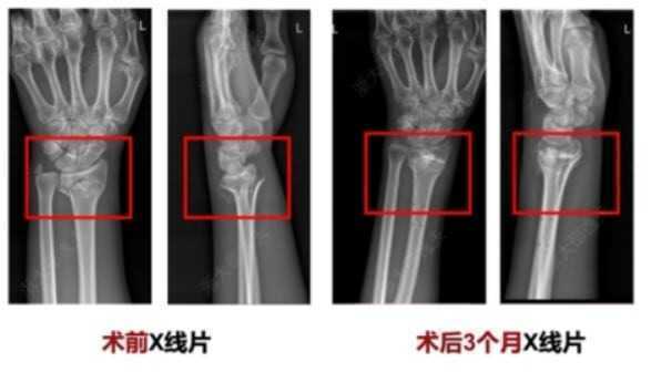 Bone-02, loại 'keo siêu dính' có thể chữa lành xương gãy chỉ trong vài phút- Ảnh 2. Bone-02, loại 'keo siêu dính' có thể chữa lành xương gãy chỉ trong vài phút- Ảnh 2.