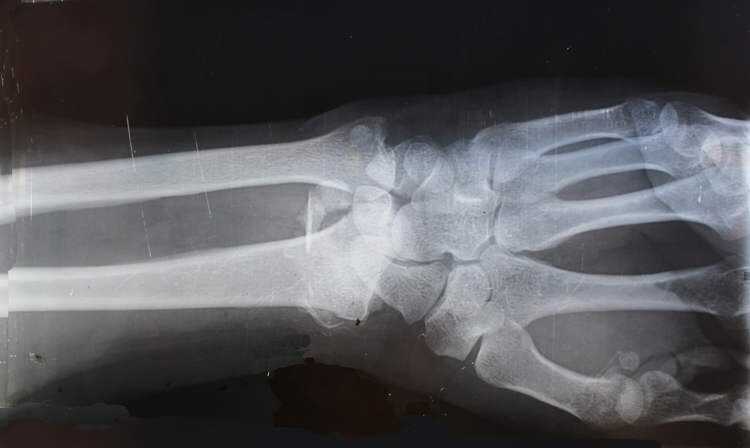 Bone-02, loại 'keo siêu dính' có thể chữa lành xương gãy chỉ trong vài phút- Ảnh 4. Bone-02, loại 'keo siêu dính' có thể chữa lành xương gãy chỉ trong vài phút- Ảnh 4.