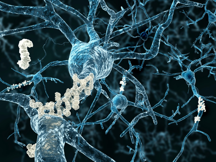 Alzheimer có thể bắt đầu từ một đoạn gene duy nhất - và AI vừa lần ra manh mối ấy