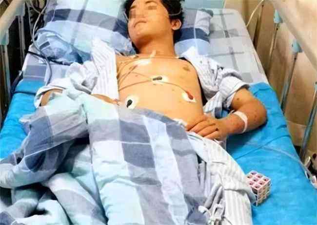 Chàng trai 17 tuổi suy thận giai đoạn cuối vì ăn quá nhiều 2 món nhưng vì "quá ngon" nên không ai từ chối