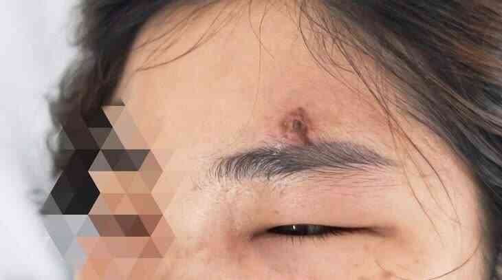 Nữ sinh 15 tuổi ở Hà Nội tử vong sau nặn mụn: Có một "tam giác tử thần" trên mặt mà bạn tuyệt đối không nên động vào- Ảnh 6. Nữ sinh 15 tuổi ở Hà Nội tử vong sau nặn mụn: Có một "tam giác tử thần" trên mặt mà bạn tuyệt đối không nên động vào- Ảnh 6.