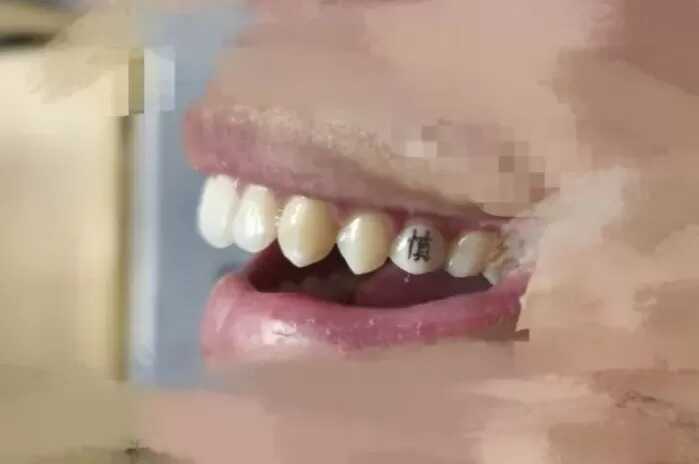 Chán hình xăm trên da, giới trẻ Trung Quốc chuyển sang xăm răng- Ảnh 2. Chán hình xăm trên da, giới trẻ Trung Quốc chuyển sang xăm răng- Ảnh 2.